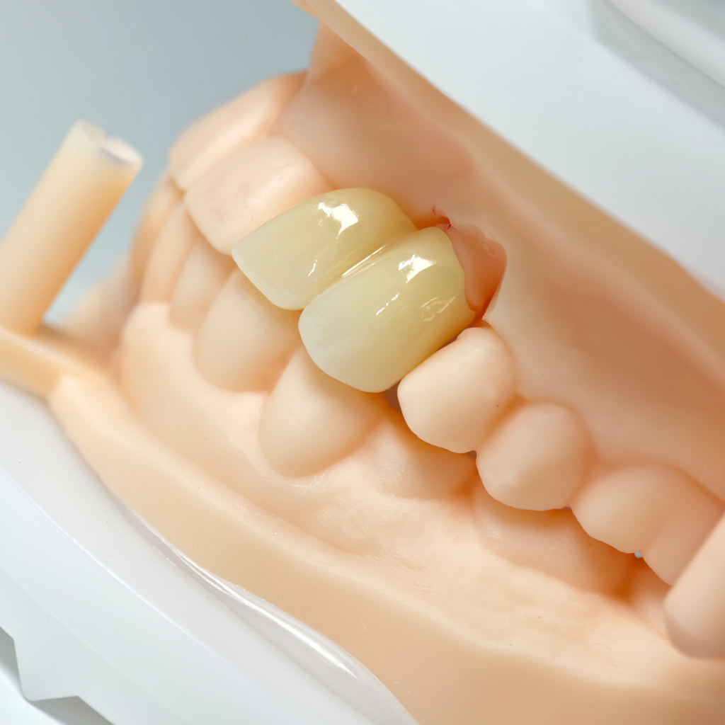 High - Strength Zirconia Crown