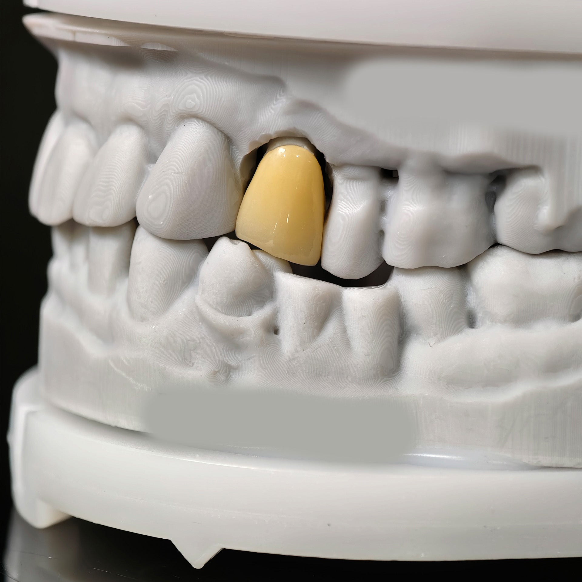 High - Strength Zirconia Crowns