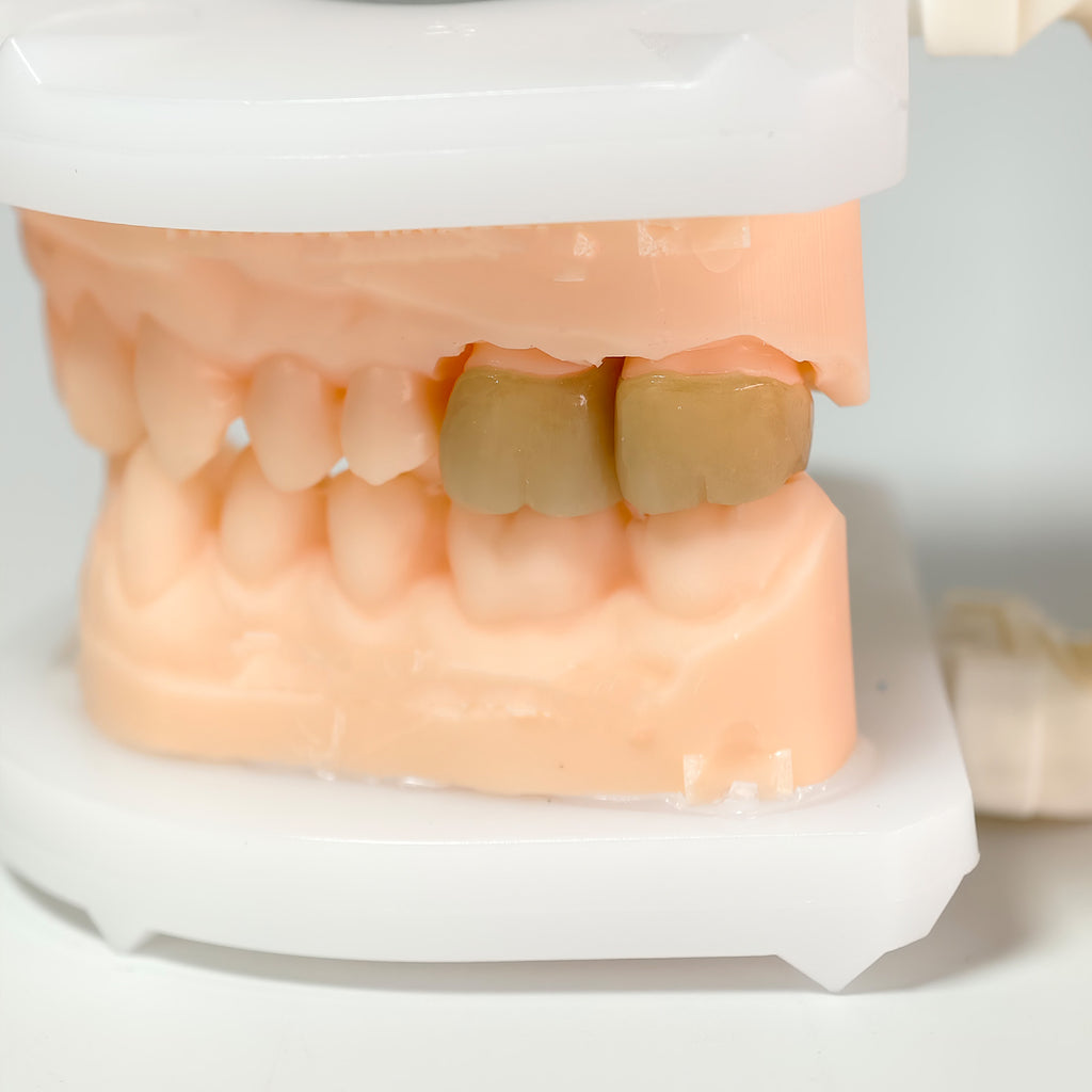 High - Strength Zirconia Crowns