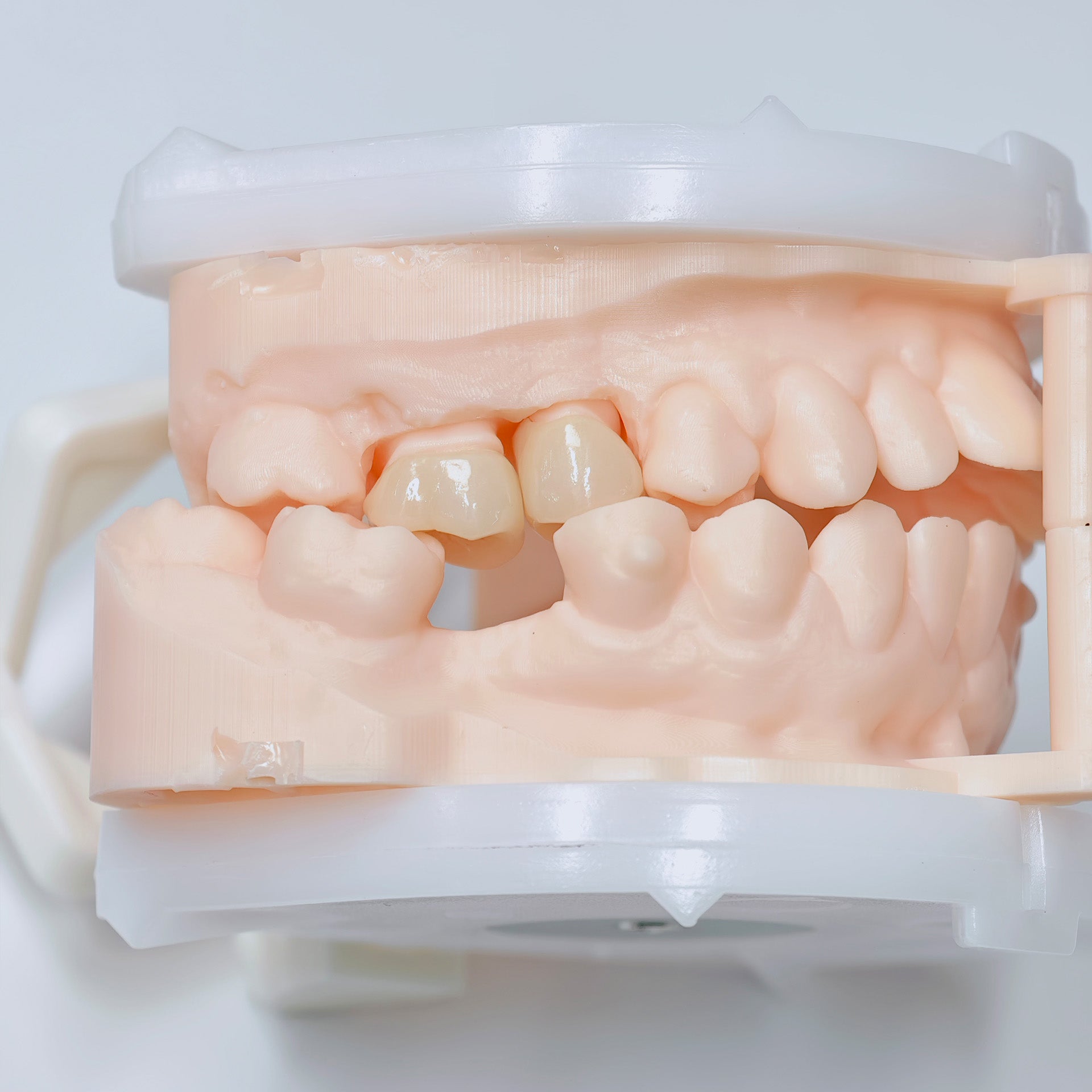 High - Strength Zirconia Crowns