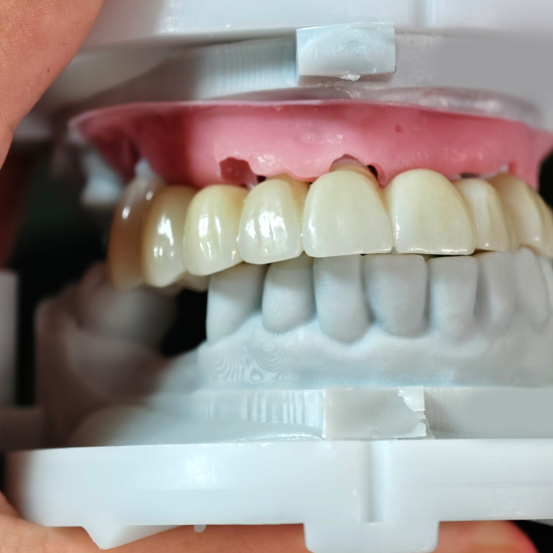 High - Strength Zirconia Crowns And Bridge