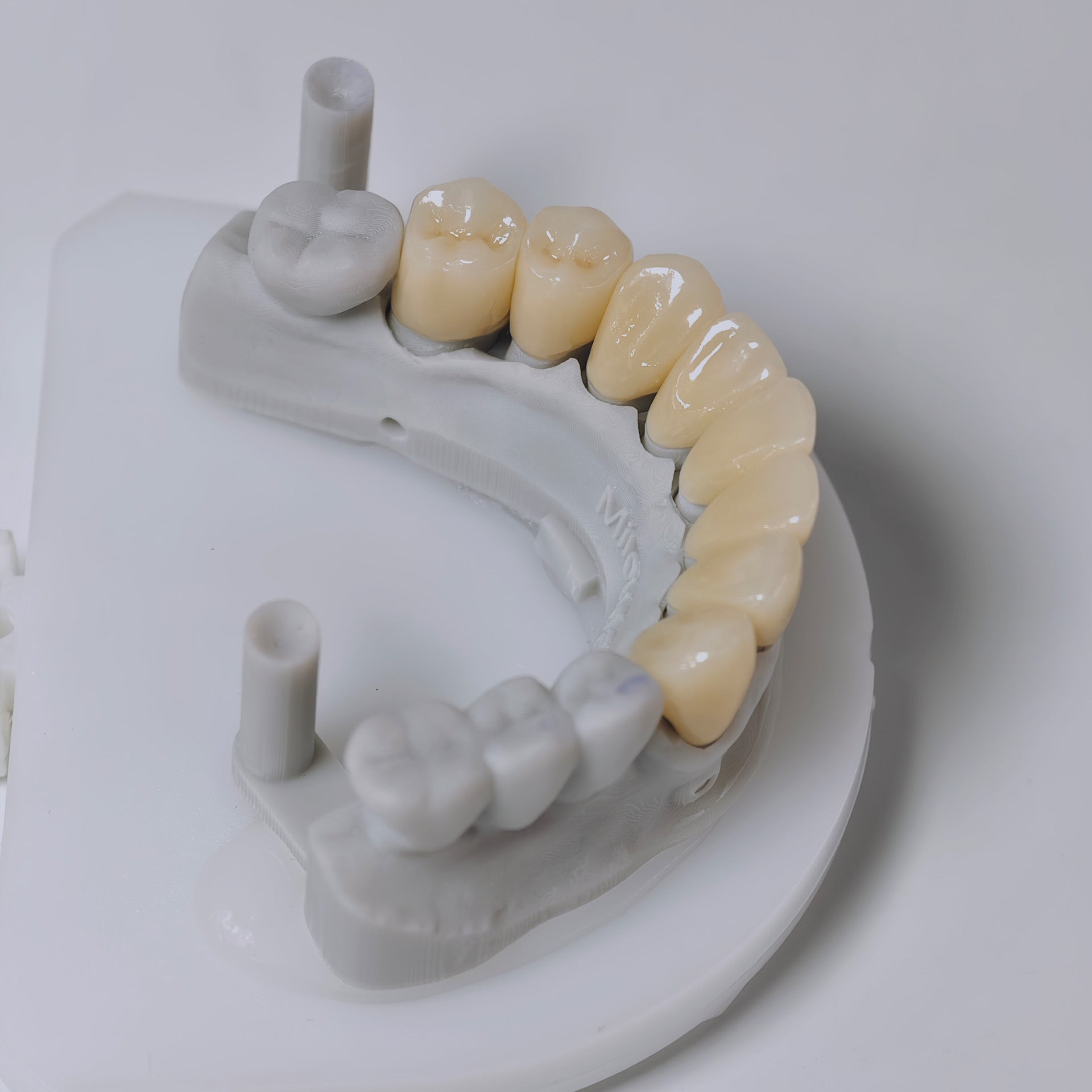 High - Strength Zirconia Crown with Post and core
