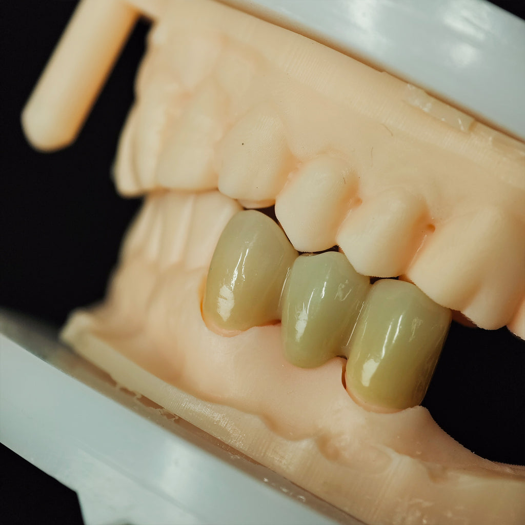High - Strength Zirconia Bridge