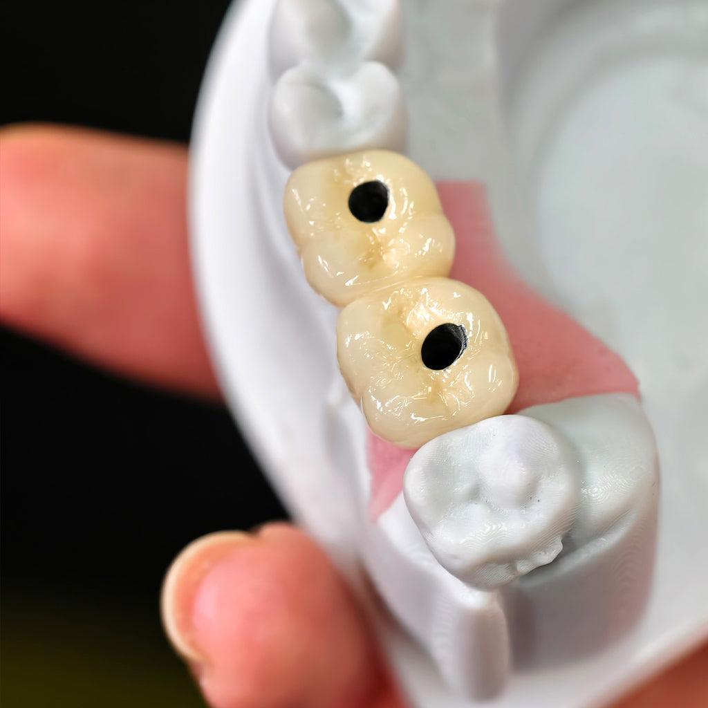 Implant-supported Co - Cr PFM Dental Bridge