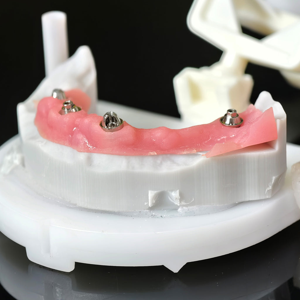 Implant-supported Co - Cr PFM Dental Bridge