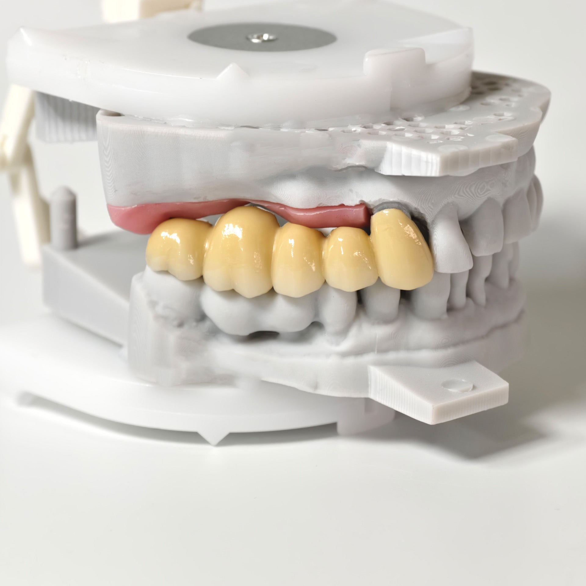 Implant-Supported PFM Single Bridge