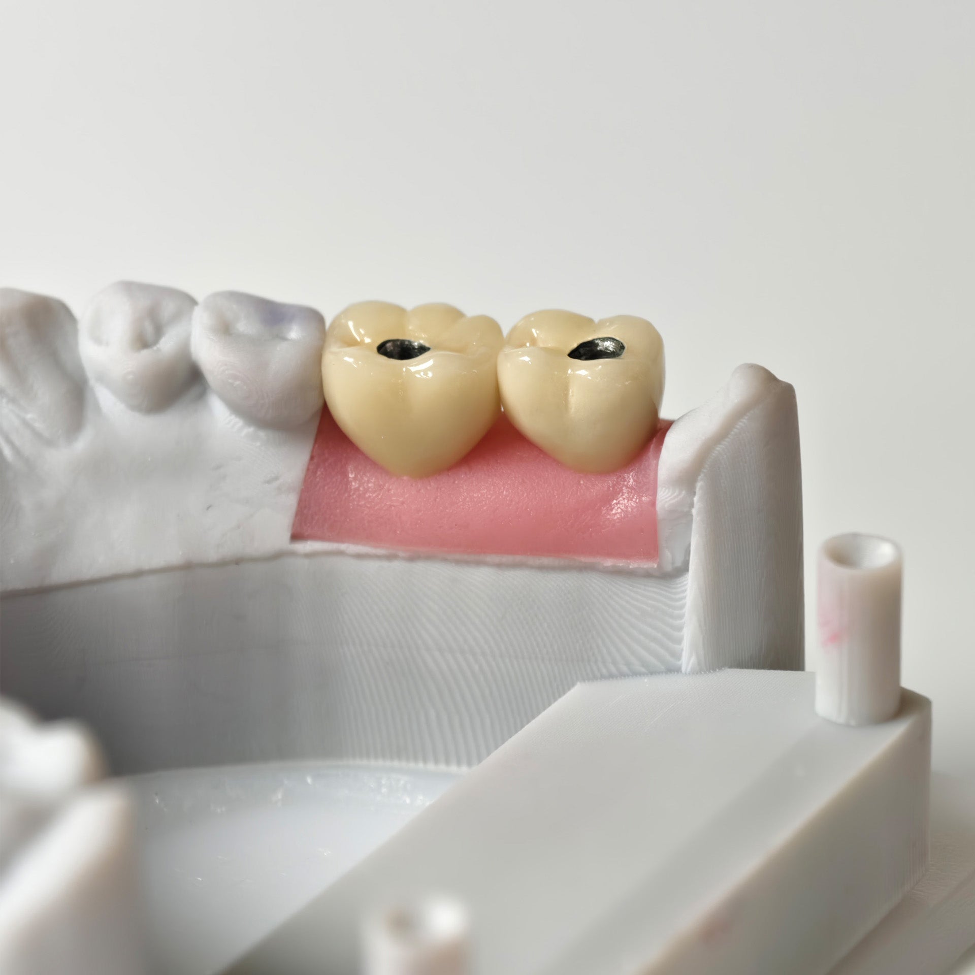 Implant-Supported PFM Single Crowns