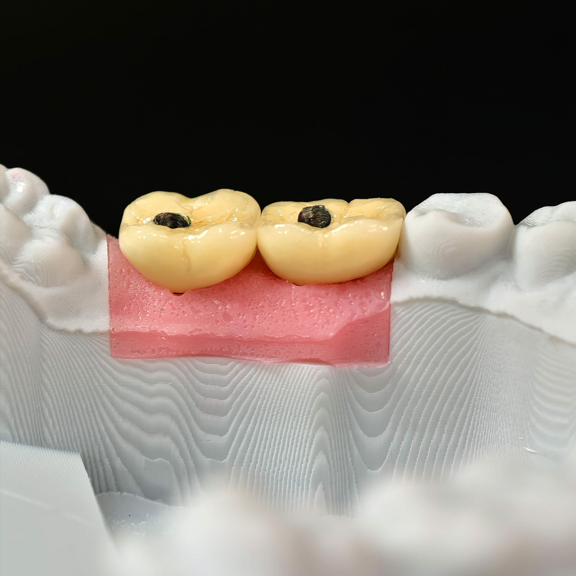 Implant-Supported PFM Single Crowns