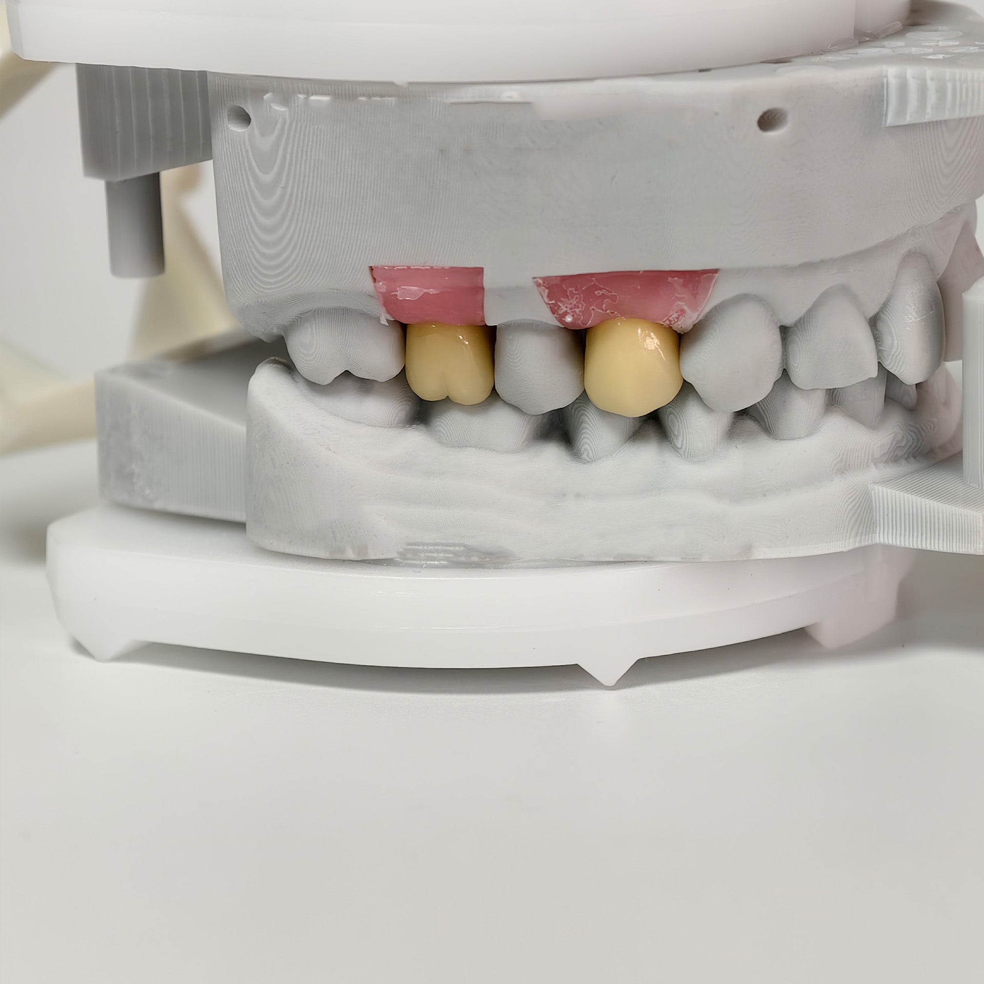 Implant-Supported PFM Single Crowns With Metal