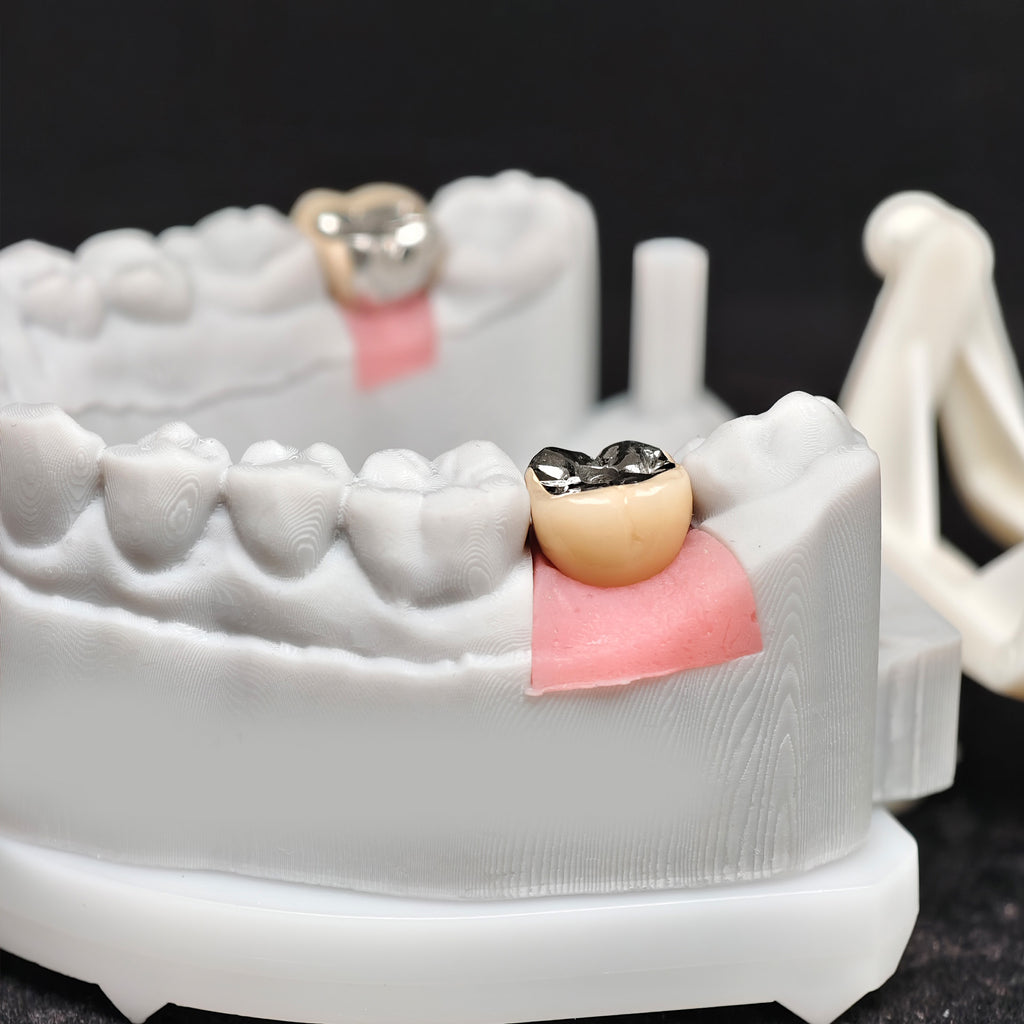 Implant-Supported PFM Single Crown With Metal