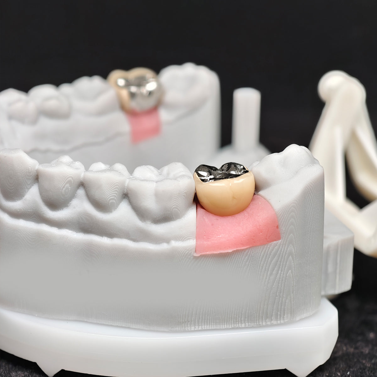 Implant-Supported PFM Single Crown With Metal