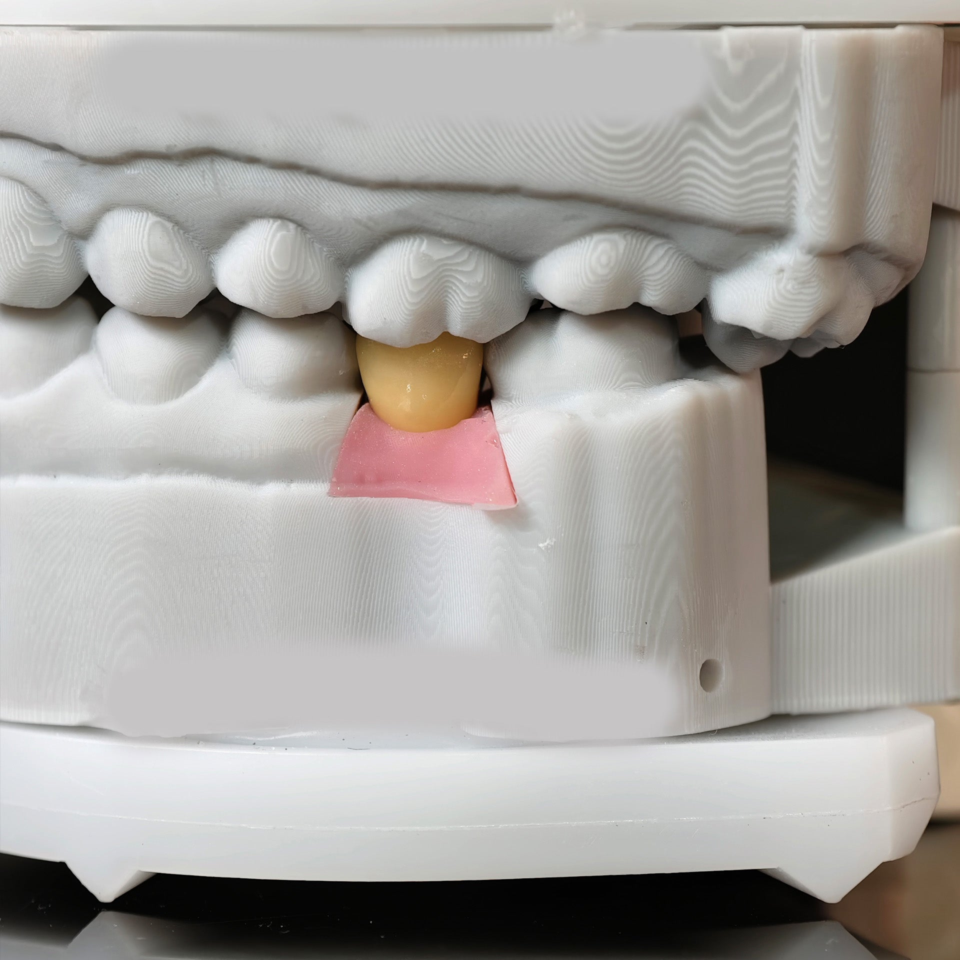 Implant-Supported PFM Single Crown With Metal
