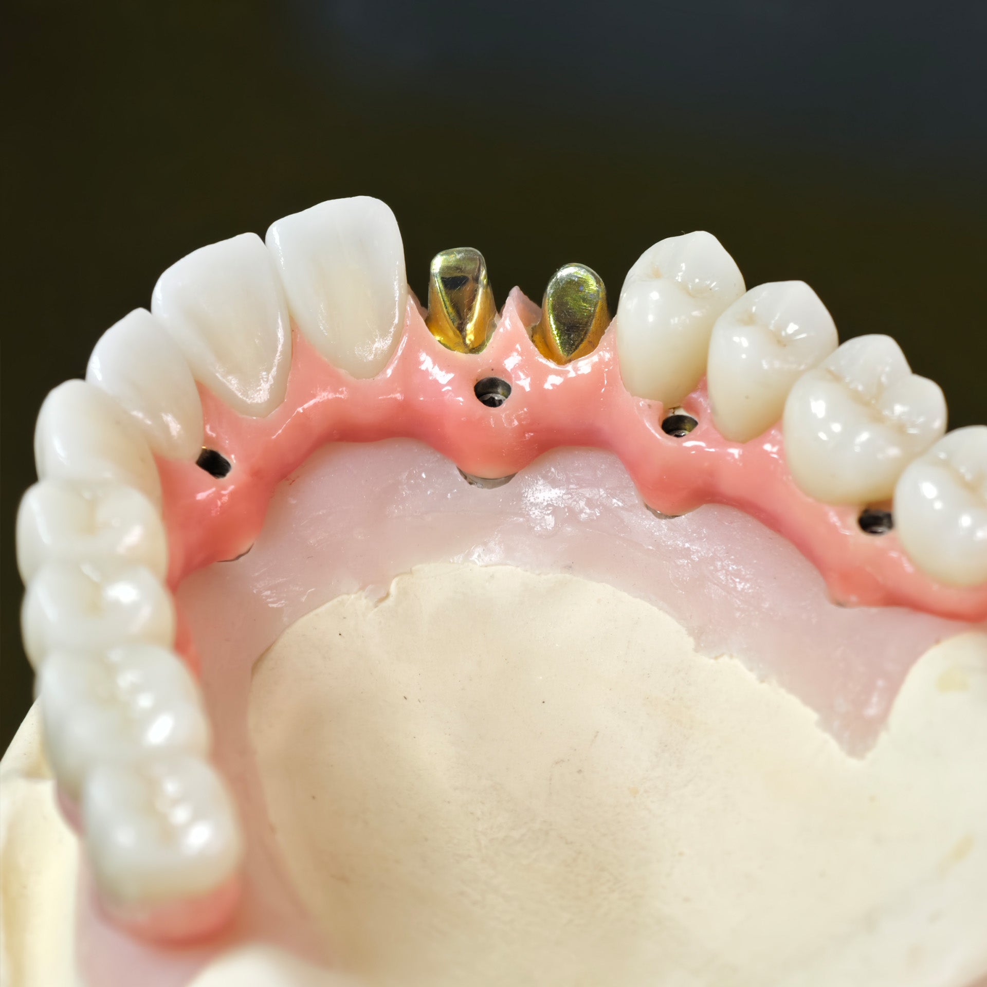 Malo Bridge With Gold-Plated Grade 5 Pure Titanium Malo Bridge