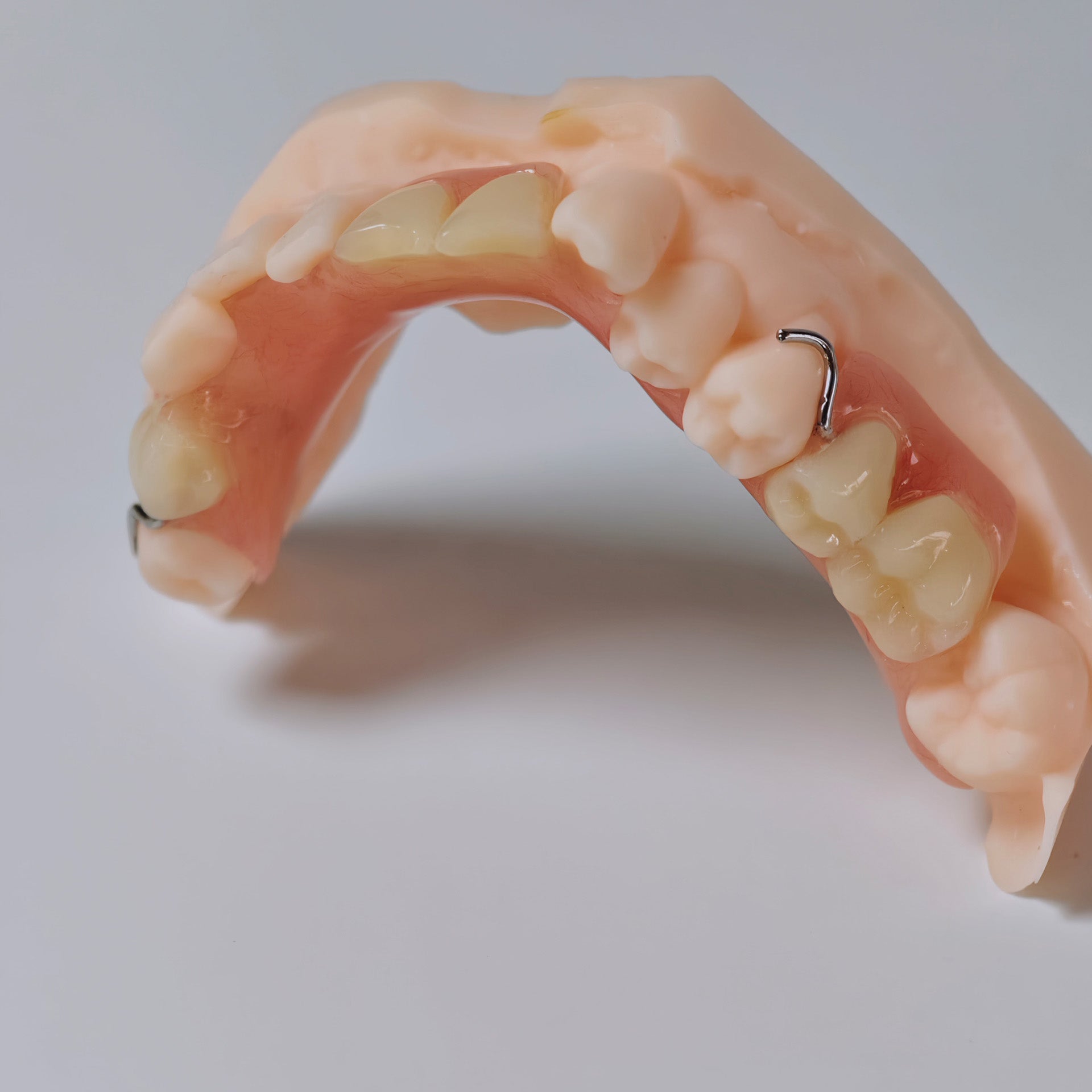 Metal Clasp Partial Denture
