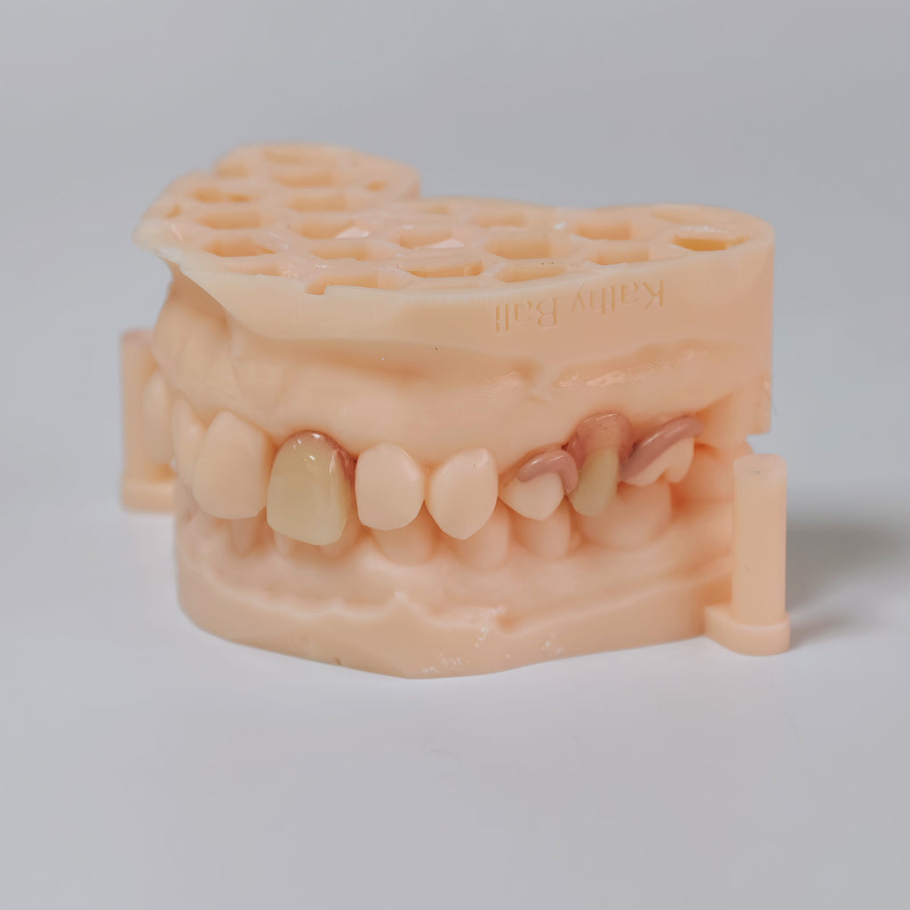 PEEK Framework Denture Metal Framework With Acrylic Denture