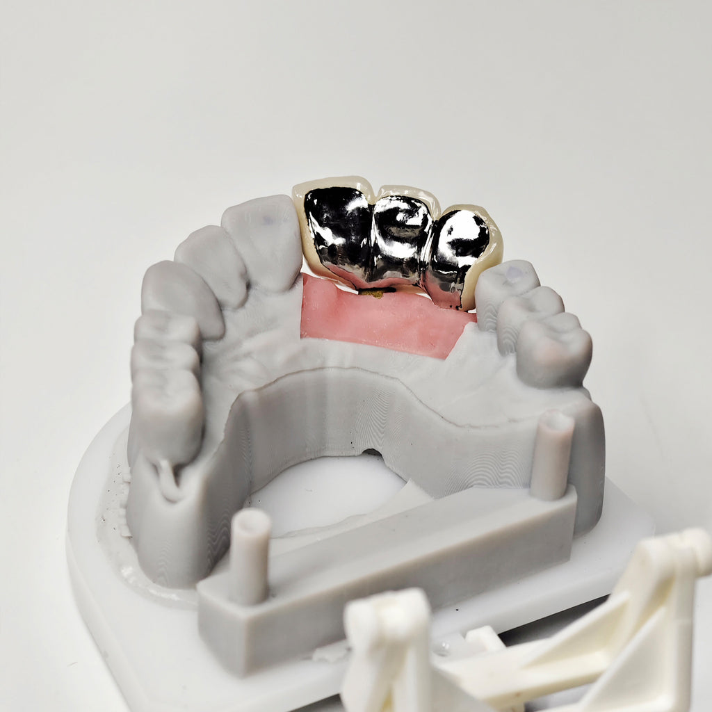 PFM Bridge With Screw-Retained And Implant Seating Guide