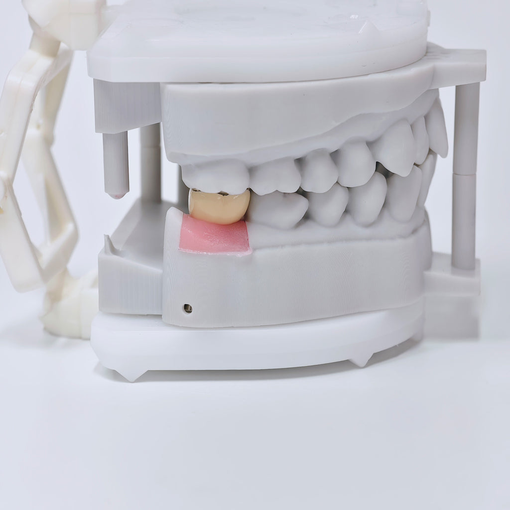 PFM Crown With Screw Retained