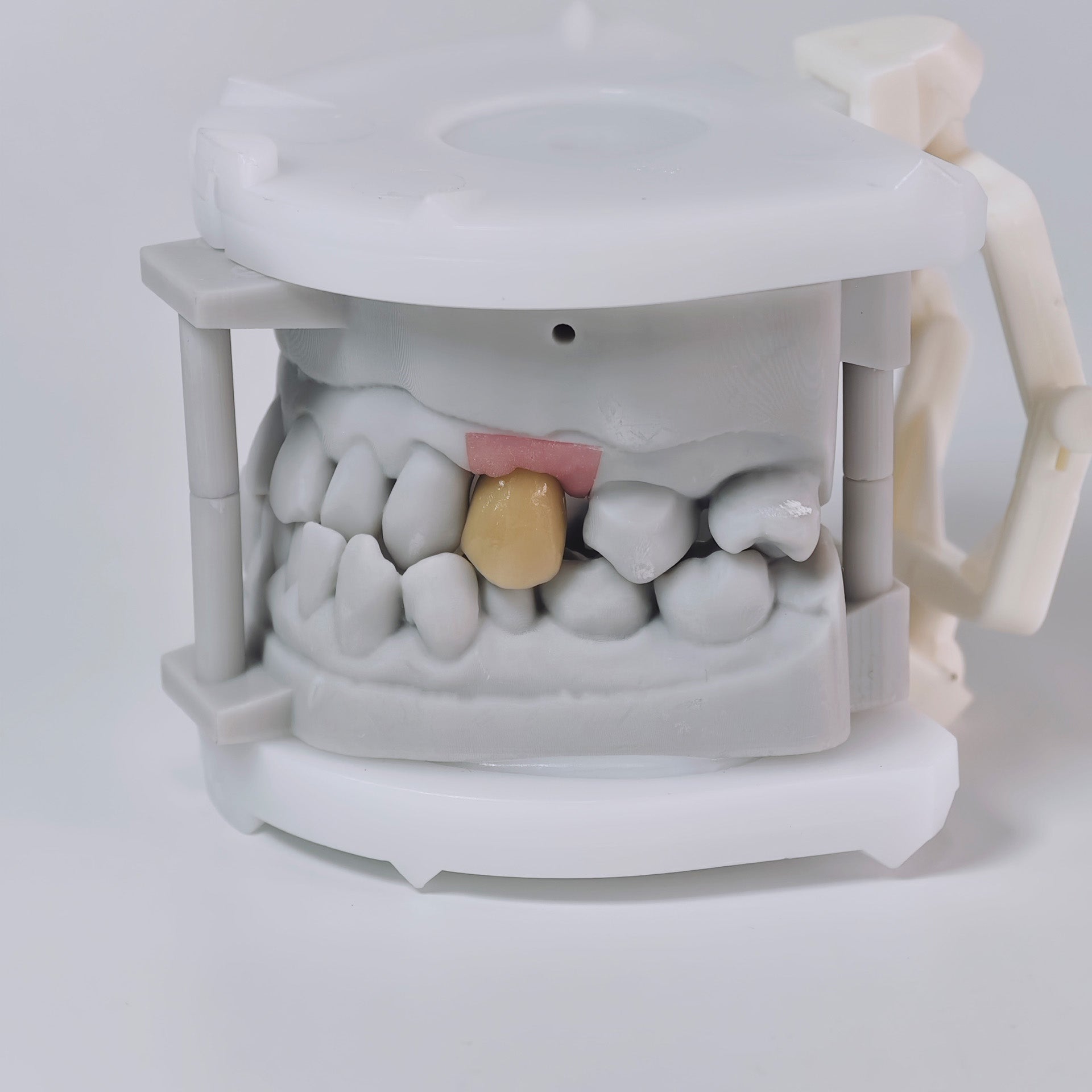 PFM Crown With Screw Retained