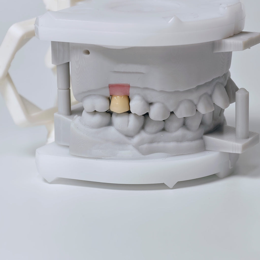 PFM Crown With Screw Retained