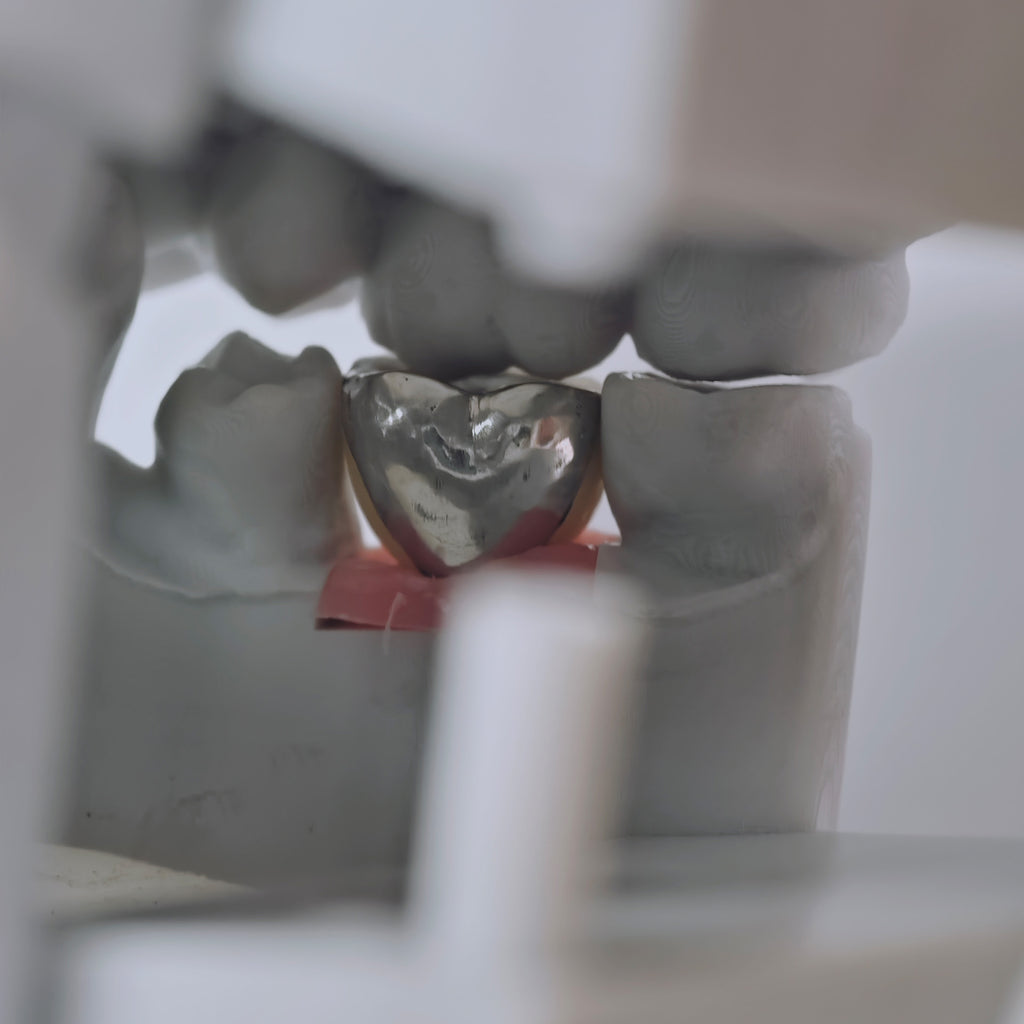 PFM Crown With Screw Retained