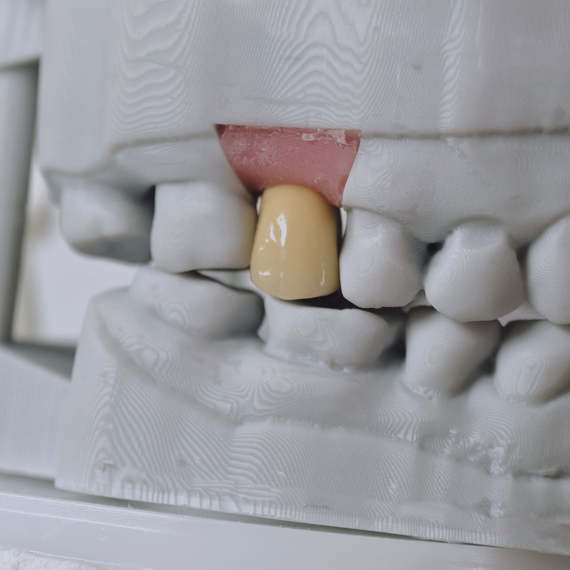 PFM Crown With Screw Retained