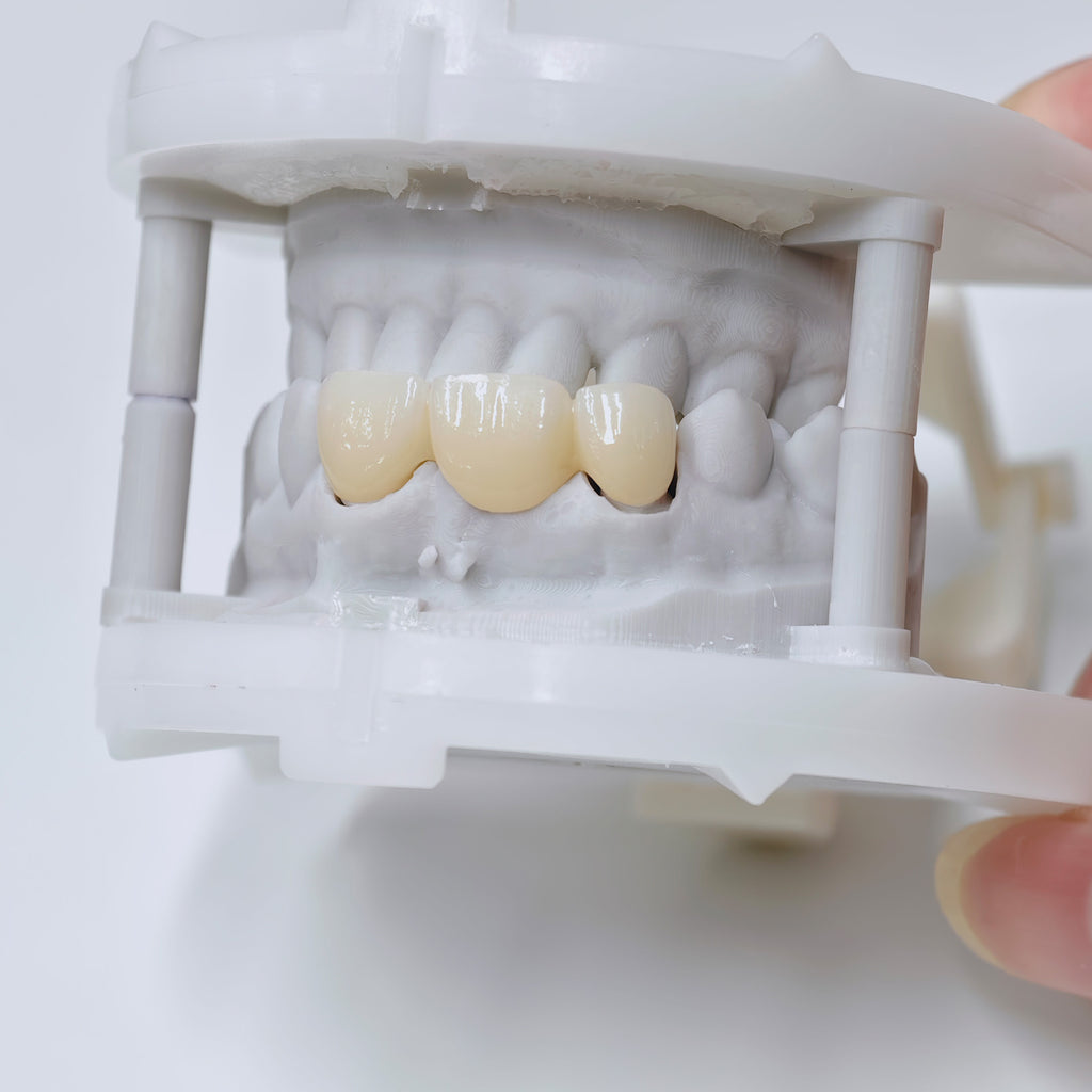 PFZ Dental Bridge – Depth And Aesthetics