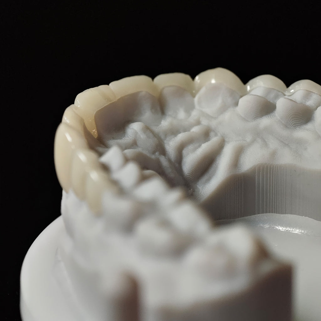 PMMA Bridge Veneer With Cement Retained