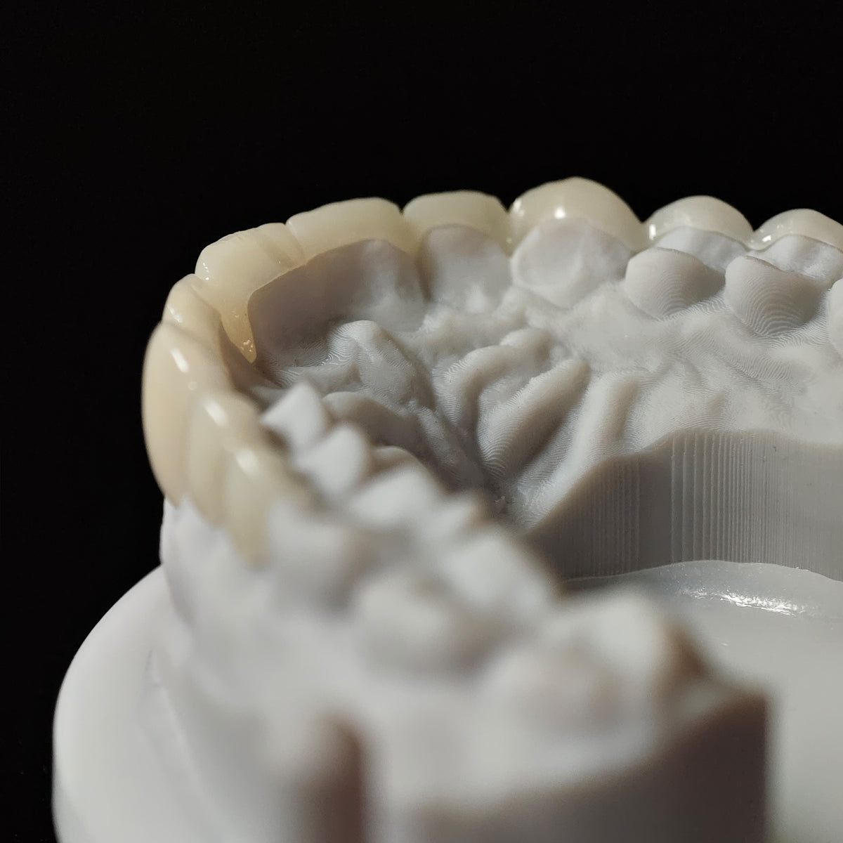 PMMA Bridge Veneer With Cement Retained