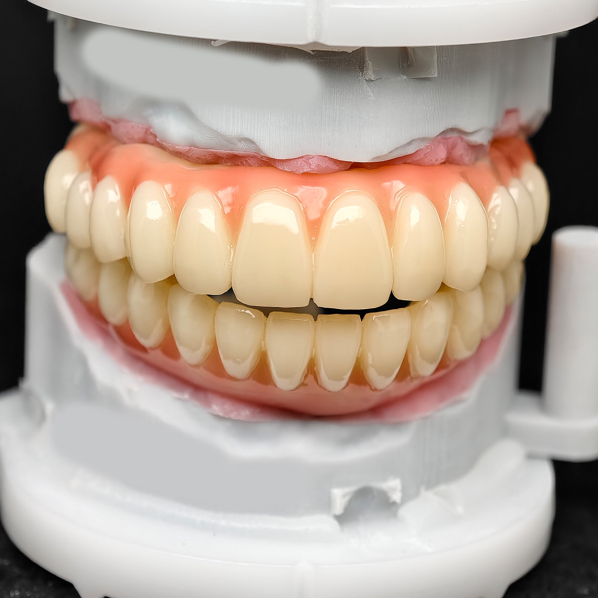 PMMA Bridge With Ti-Base Screw Retained Trying For Full Arch Restoration