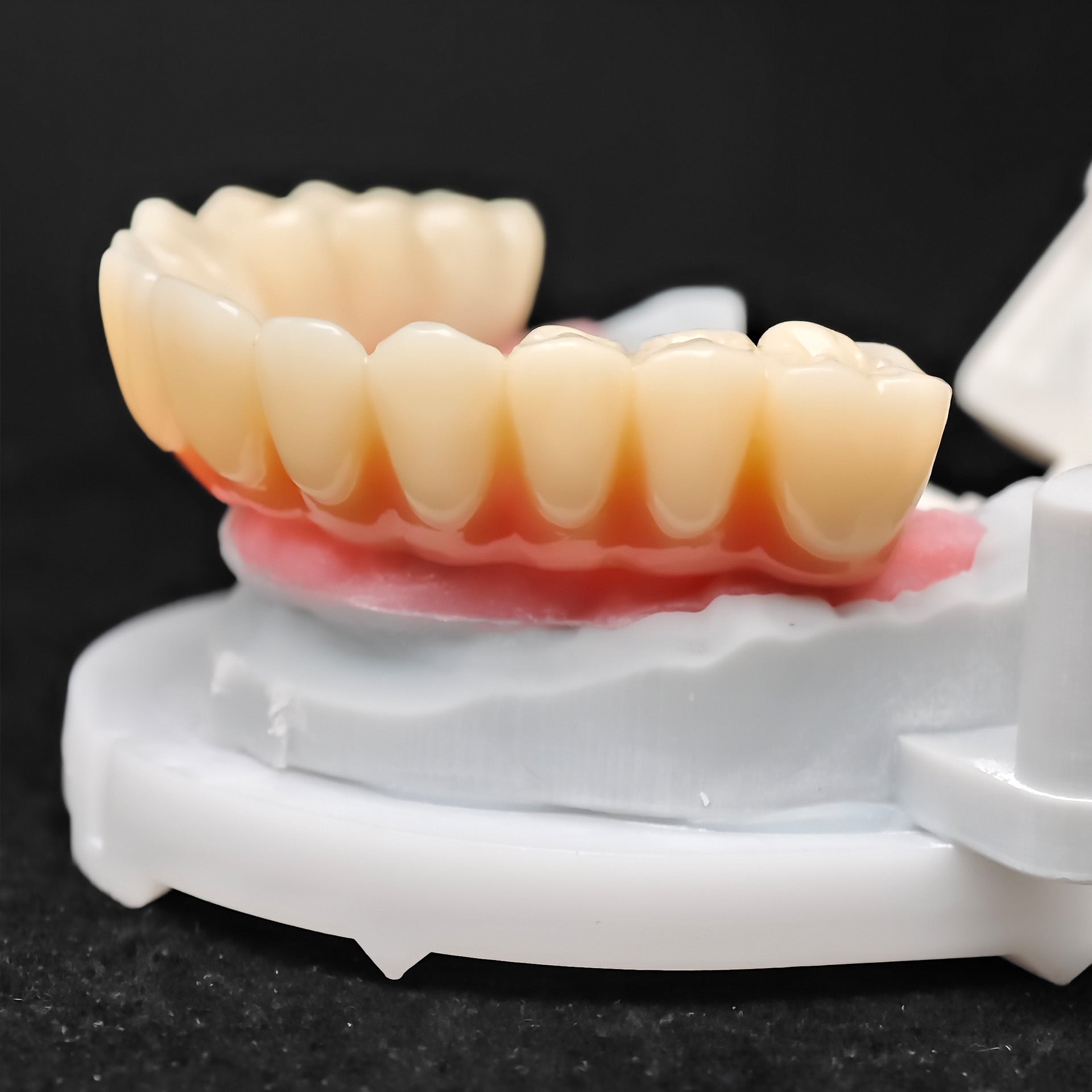 PMMA Bridge With Ti-Base Screw Retained Trying For Full Arch Restoration