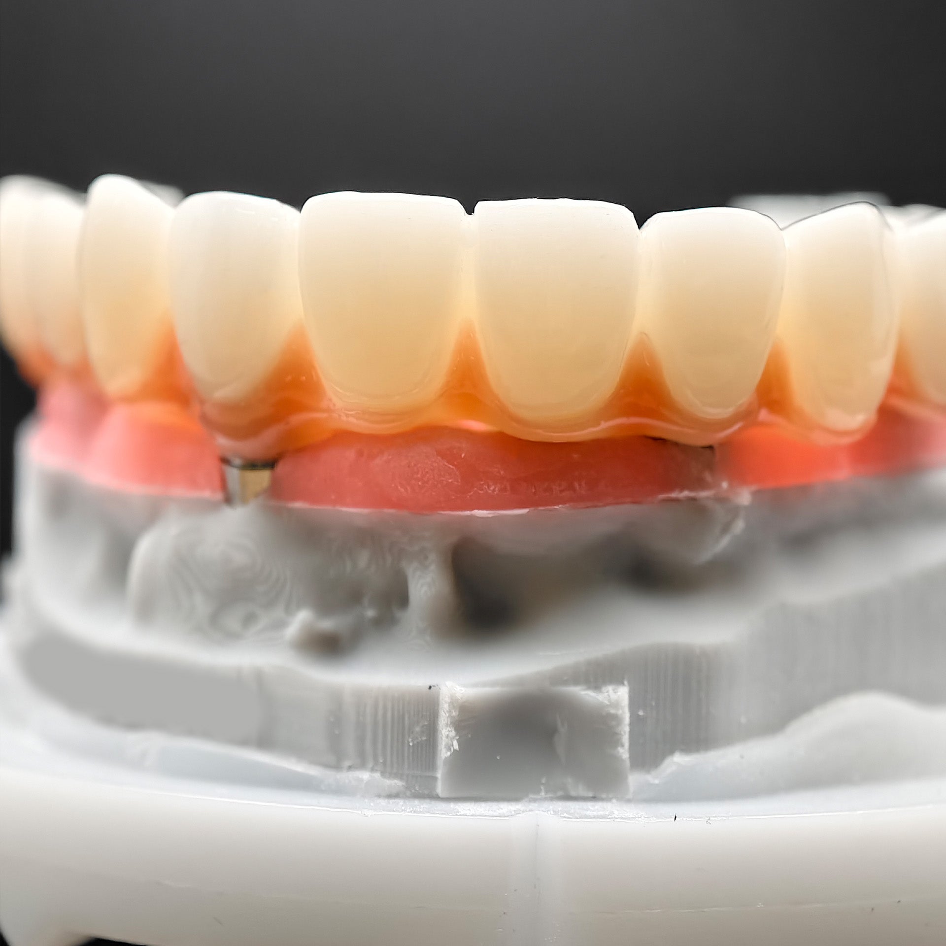 PMMA Bridge With Ti-Base Screw Retained Trying For Full Arch Restoration
