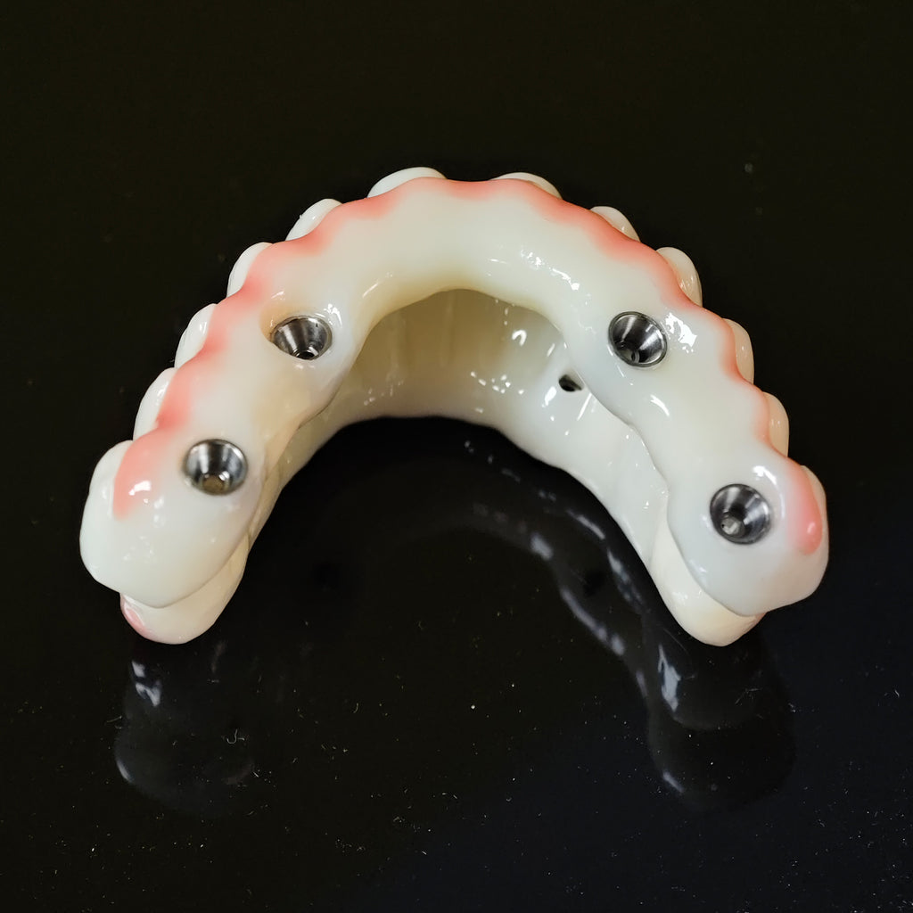 PMMA Bridge With Ti-Base Screw Retained Trying For Full Arch Restoration
