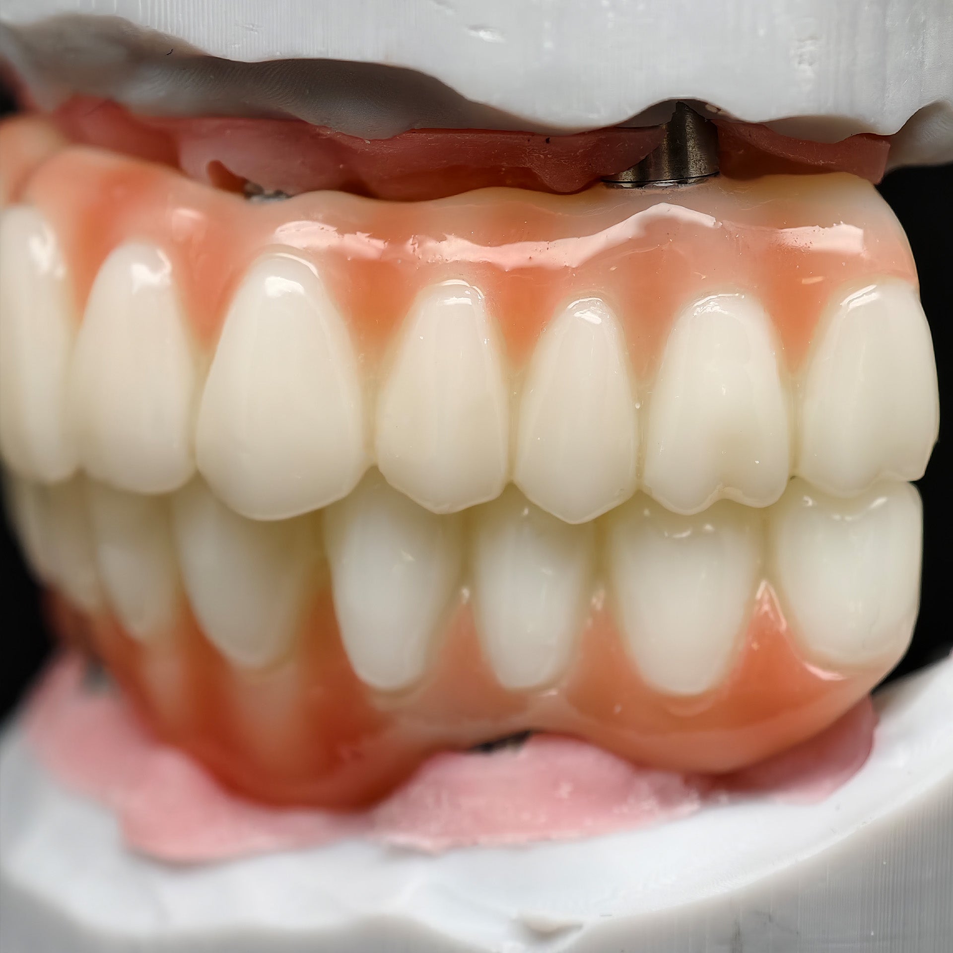 PMMA Bridge With Ti-Base Screw Retained Trying For Full Arch Restoration