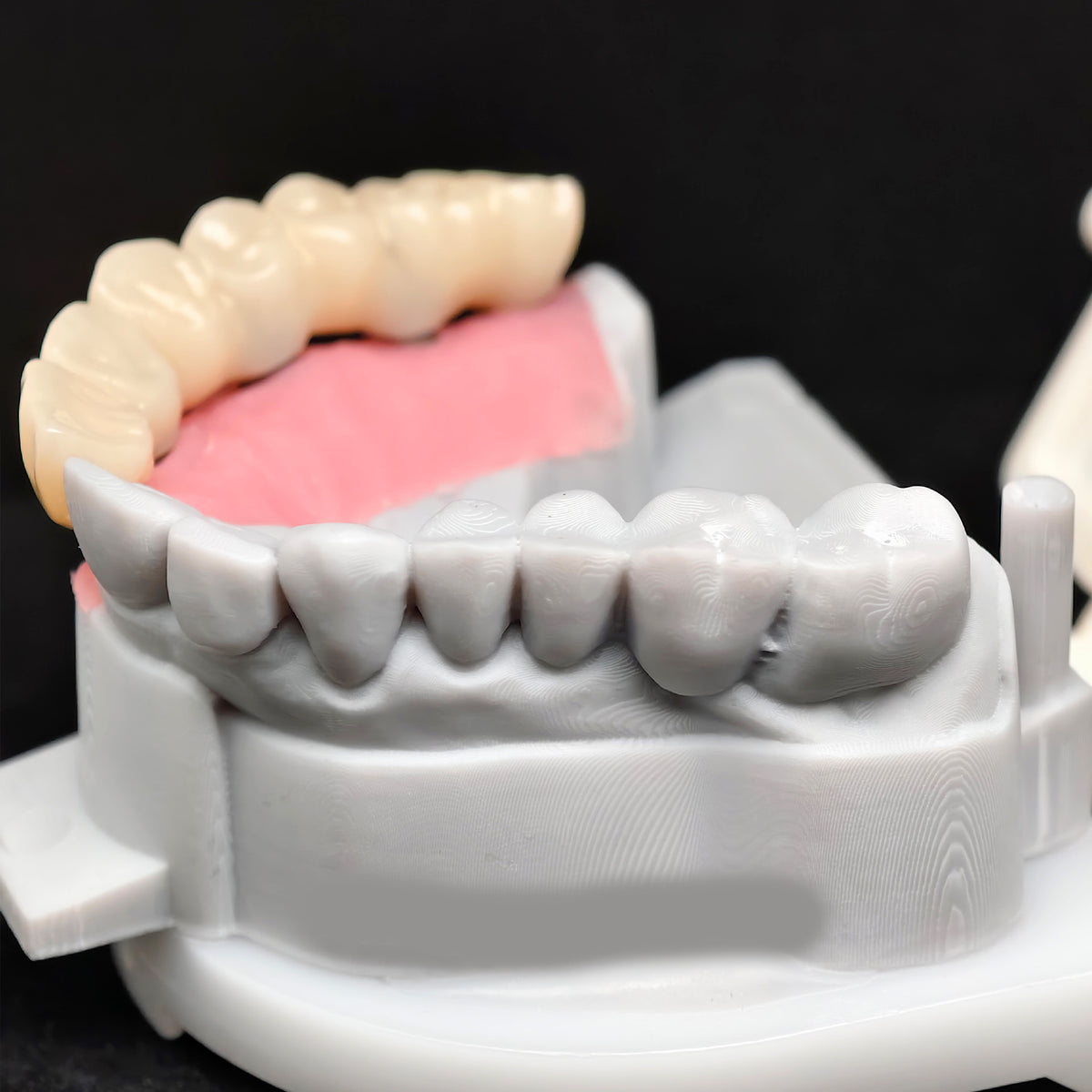 PMMA Bridge With Custom Abutment And Implant Seating Guide