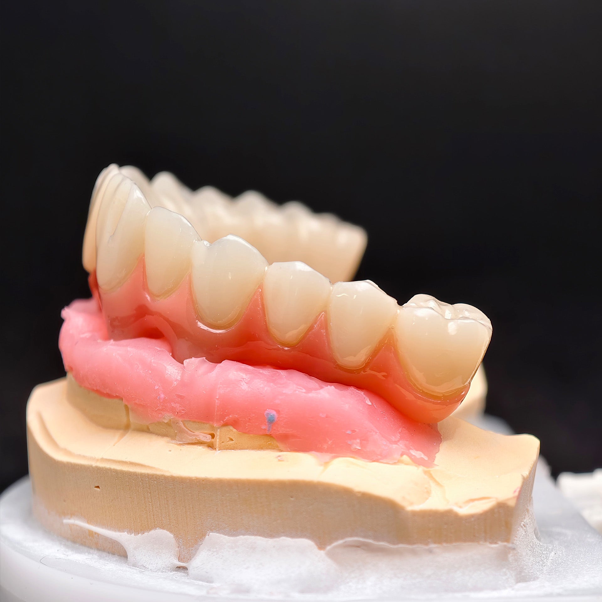 Pmma Bridge With Screw-Retained
