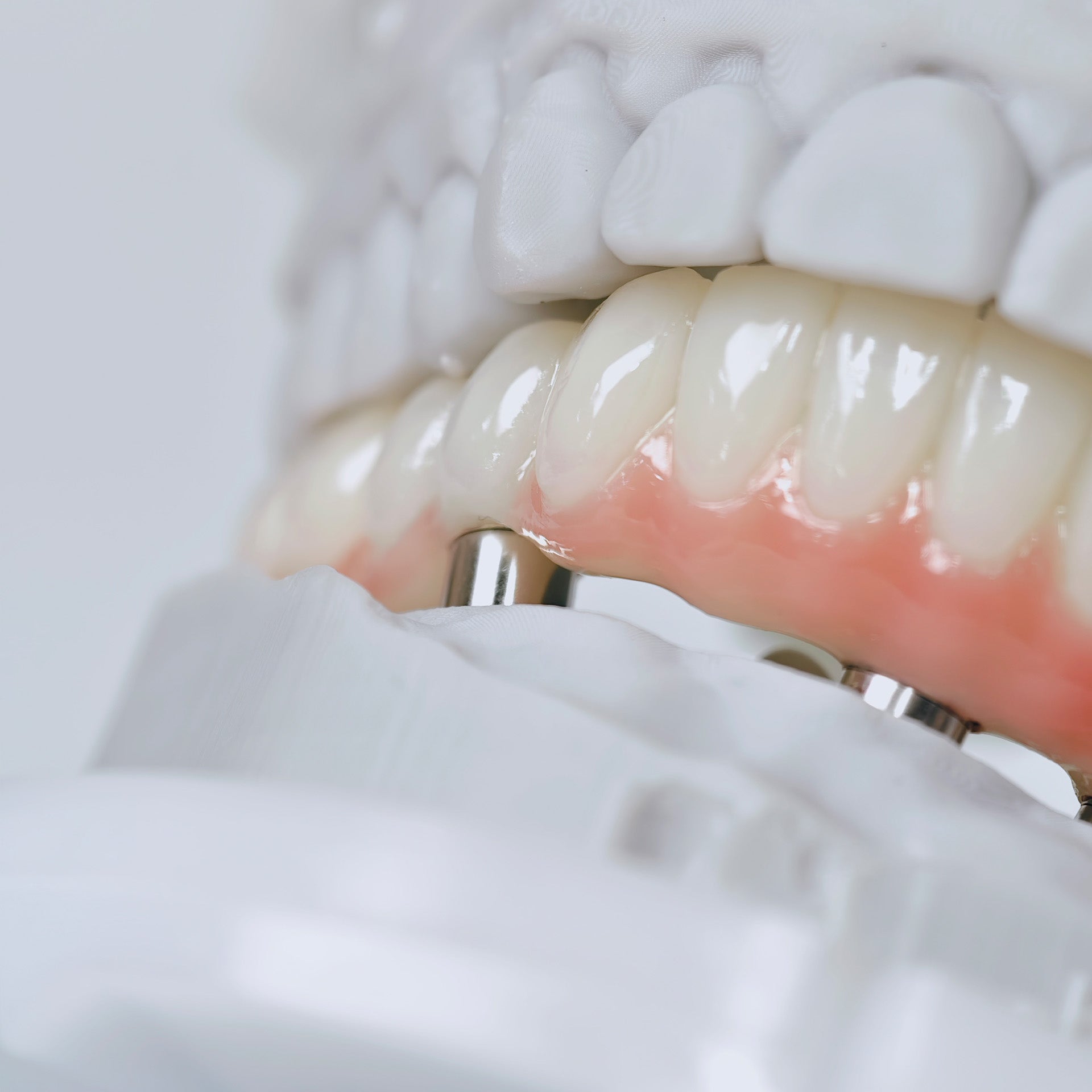 PMMA Bridge With Screw Retained