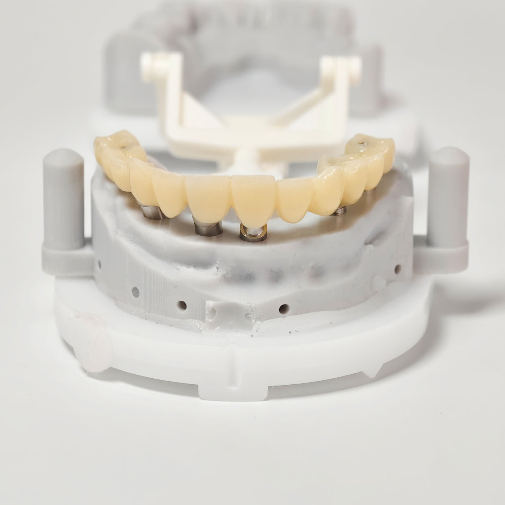 PMMA Bridge With Screw Retained
