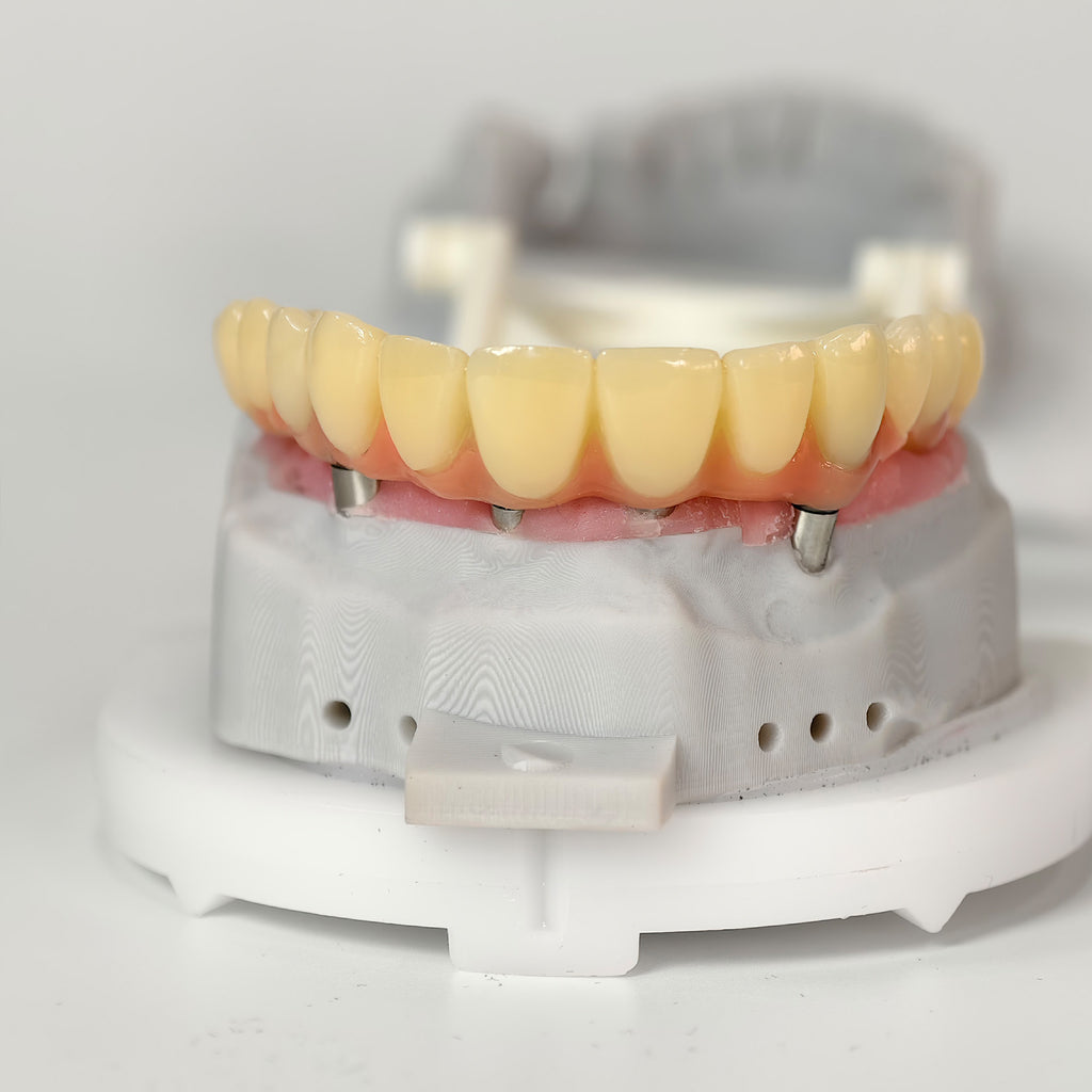 PMMA Bridge With Screw Retained