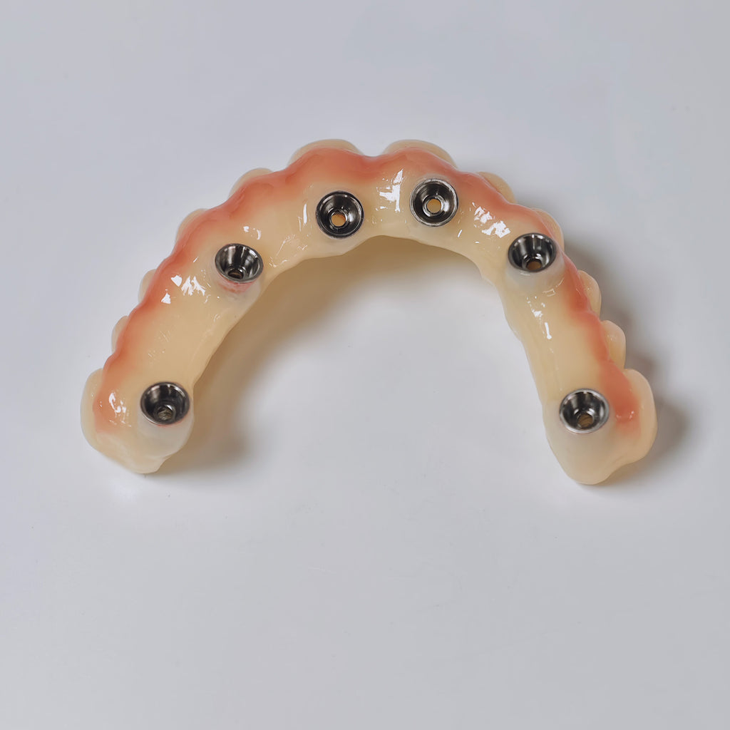 PMMA Bridge With Screw Retained