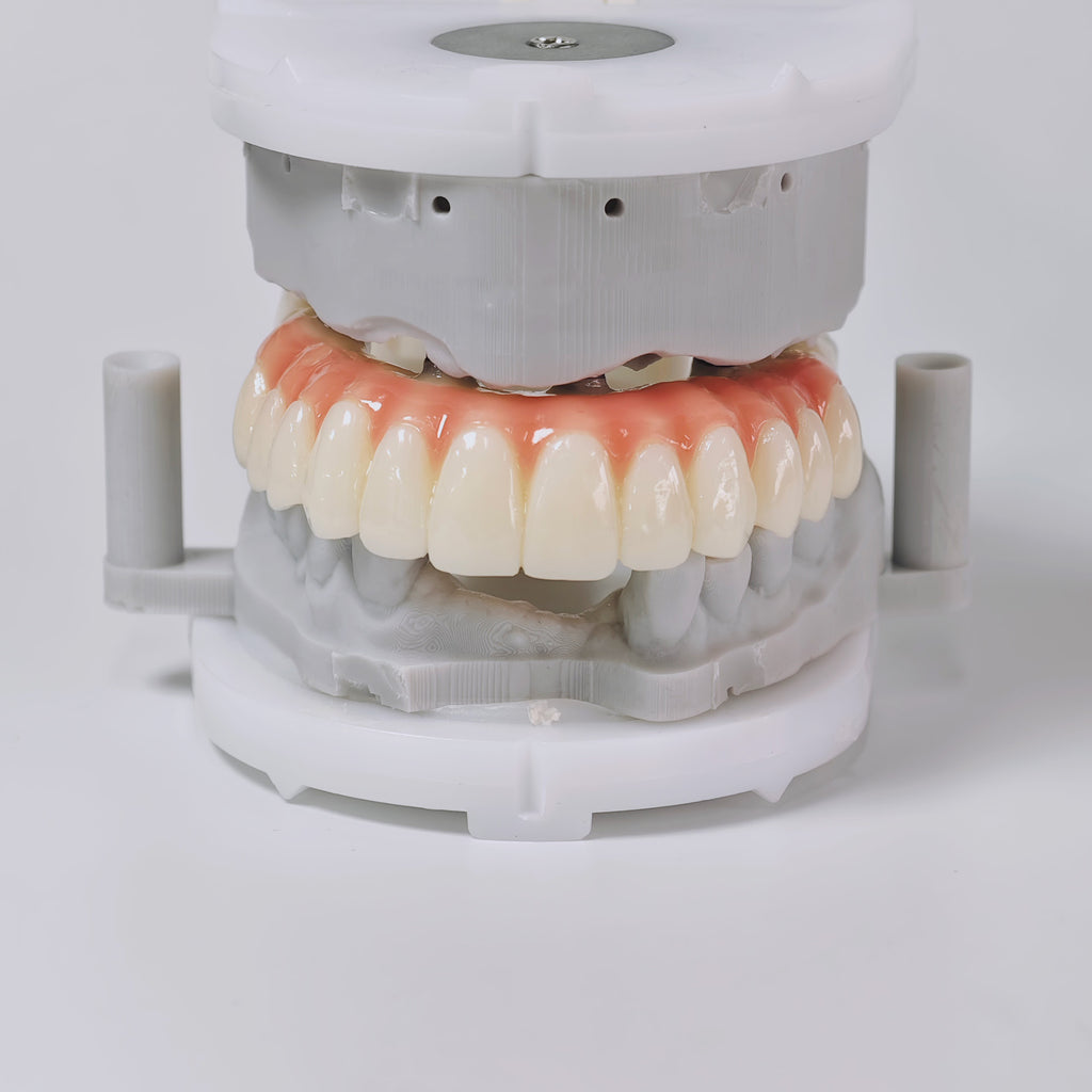 PMMA Bridge With Screw Retained