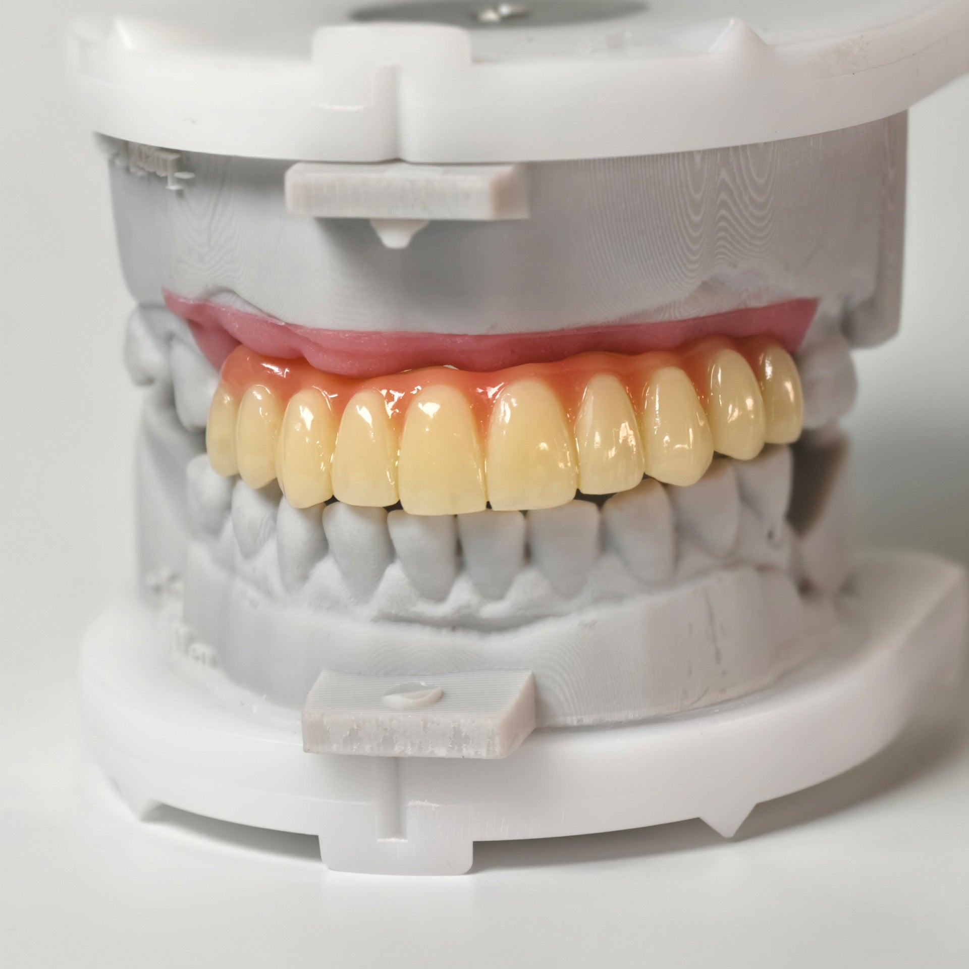 PMMA Bridge With Screw Retained