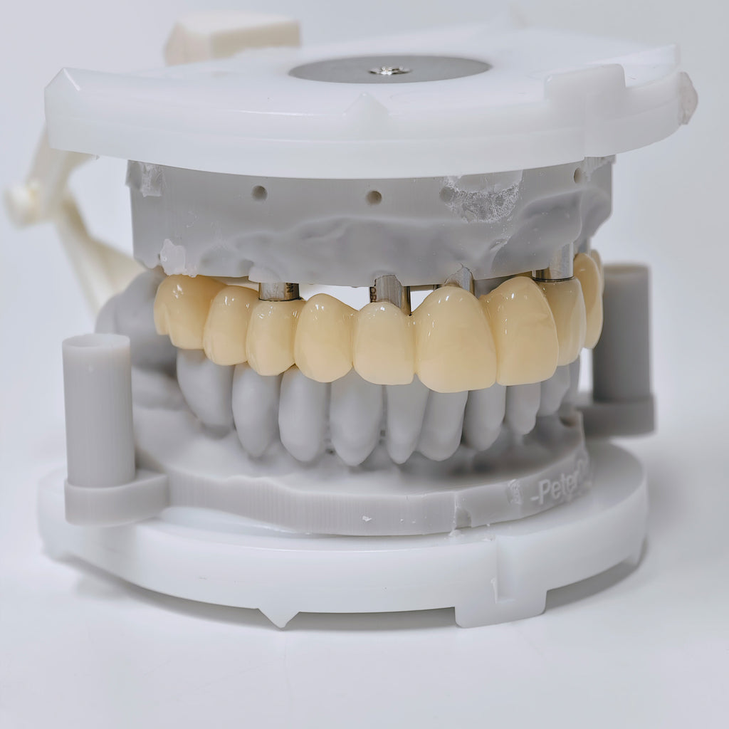 PMMA Bridge With Screw Retained