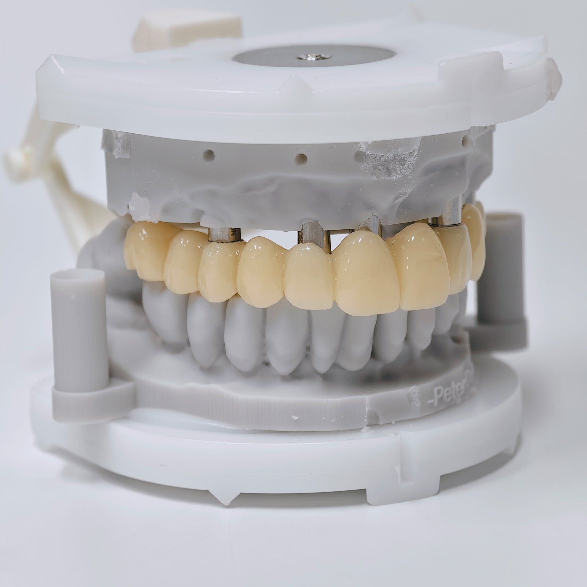 PMMA Bridge With Screw Retained