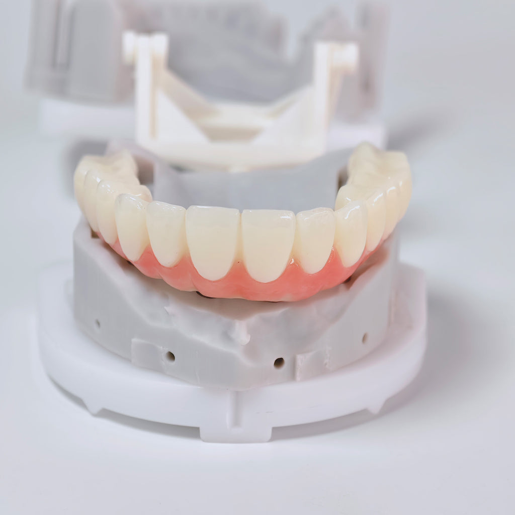 PMMA Bridge With Screw Retained