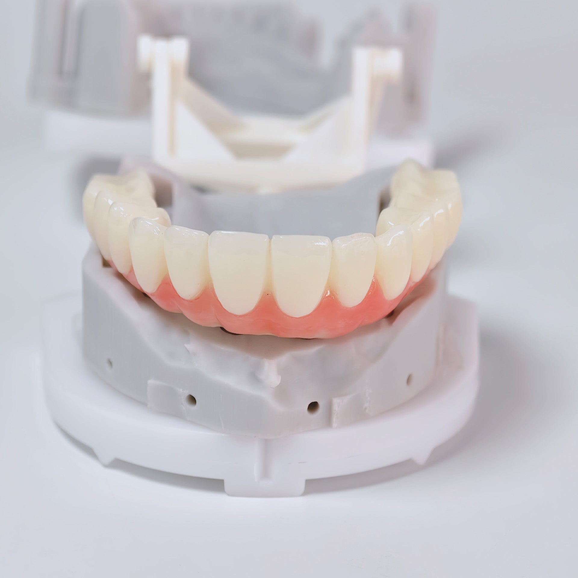 PMMA Bridge With Screw Retained