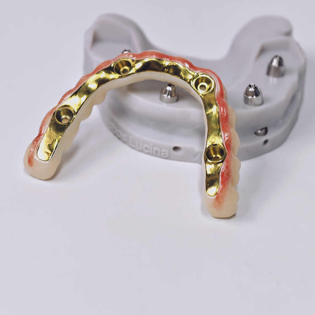 Ti-Bar Titanium Gold-Plated Metal Frame With Zirconia Bridge And Screw Retained