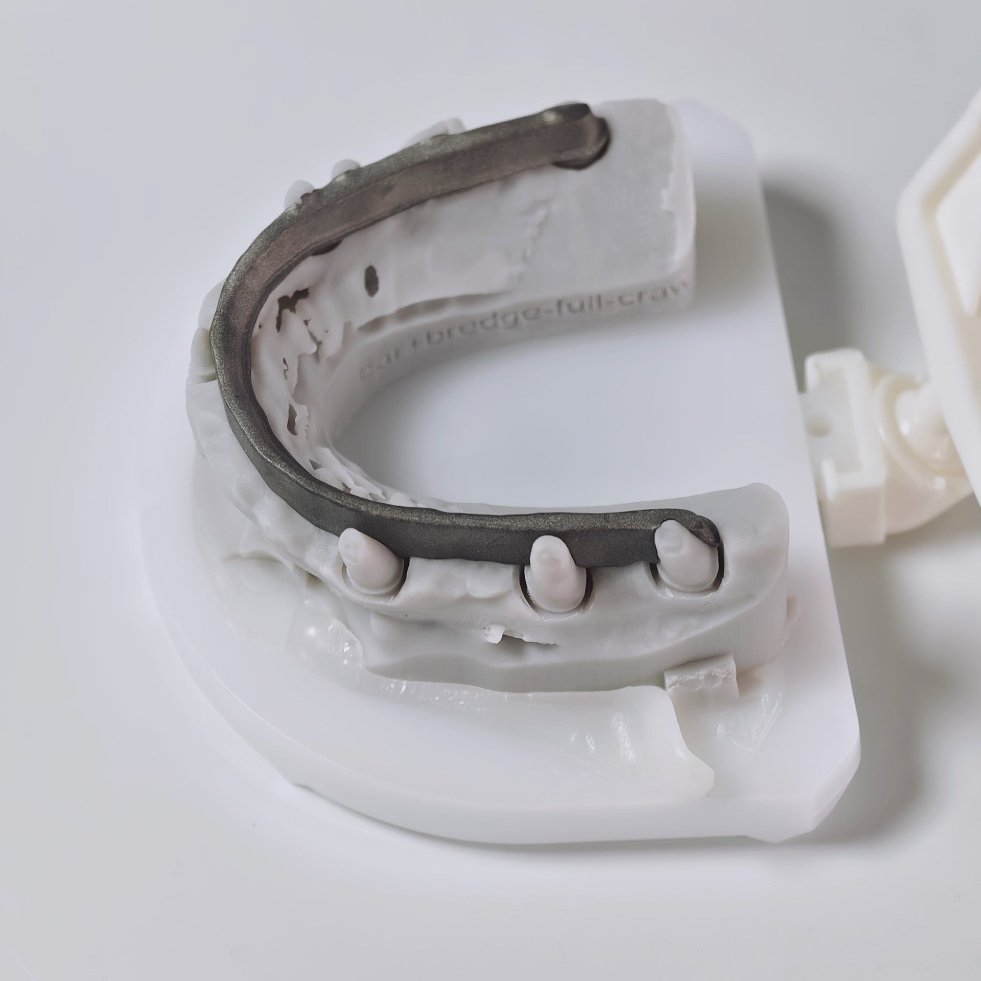 Ti-Bar Titanium Nitride Metal Frame With Zirconia Bridge And Cement Retained