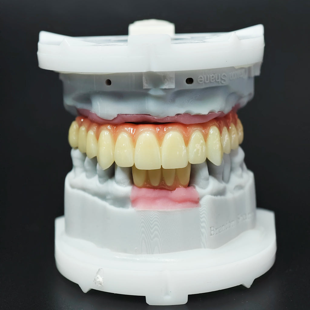 Ti-Bar Titanium Nitride Metal Frame With Zirconia Bridge For Full Arch Restoration