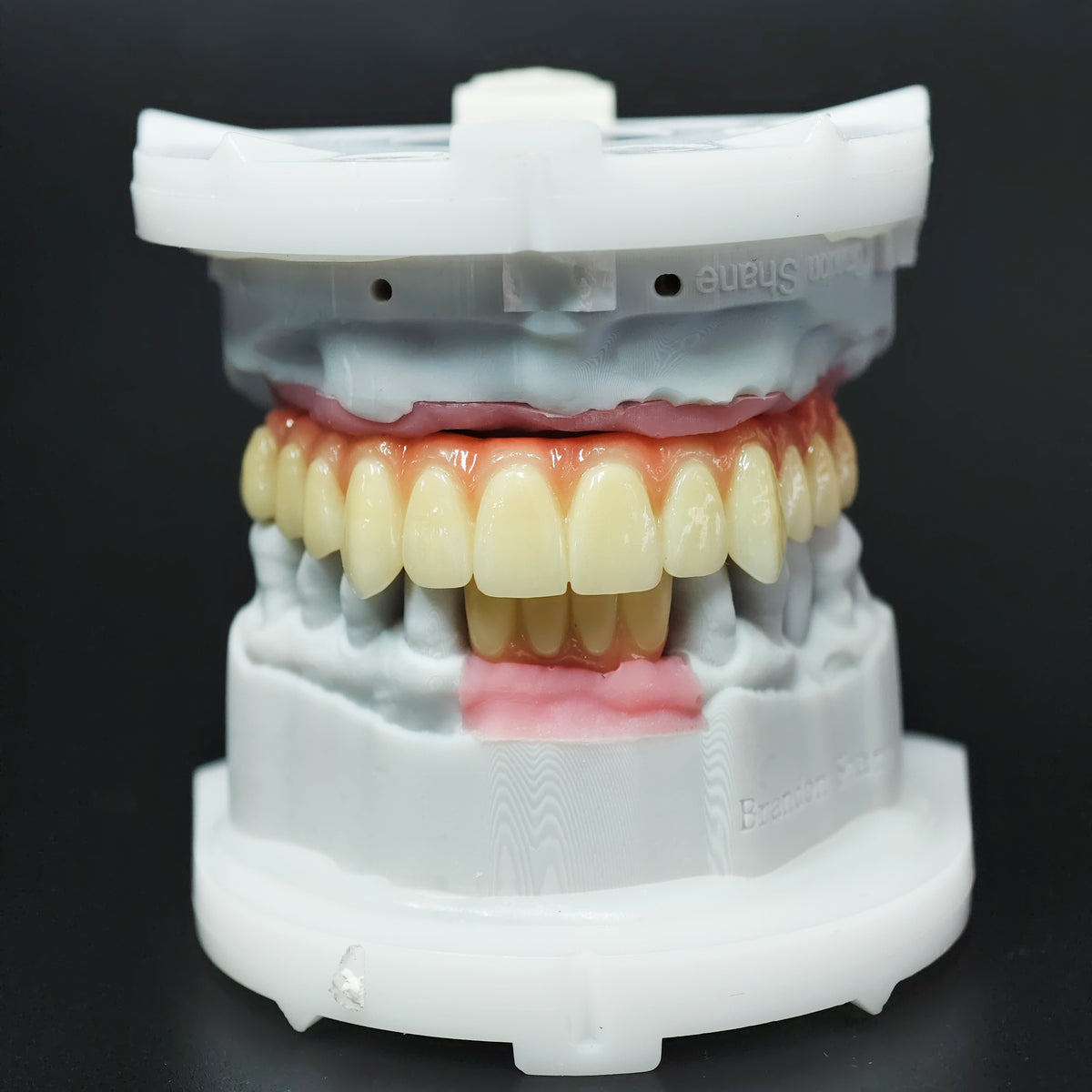 Ti-Bar Titanium Nitride Metal Frame With Zirconia Bridge For Full Arch Restoration