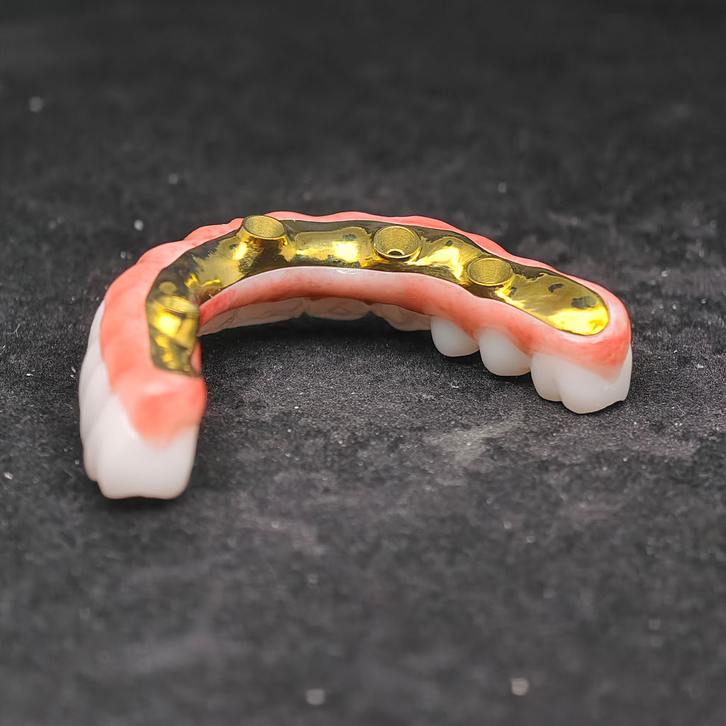 Ti-Bar Titanium Nitride Metal Frame With Zirconia Bridge For Full Arch Restoration